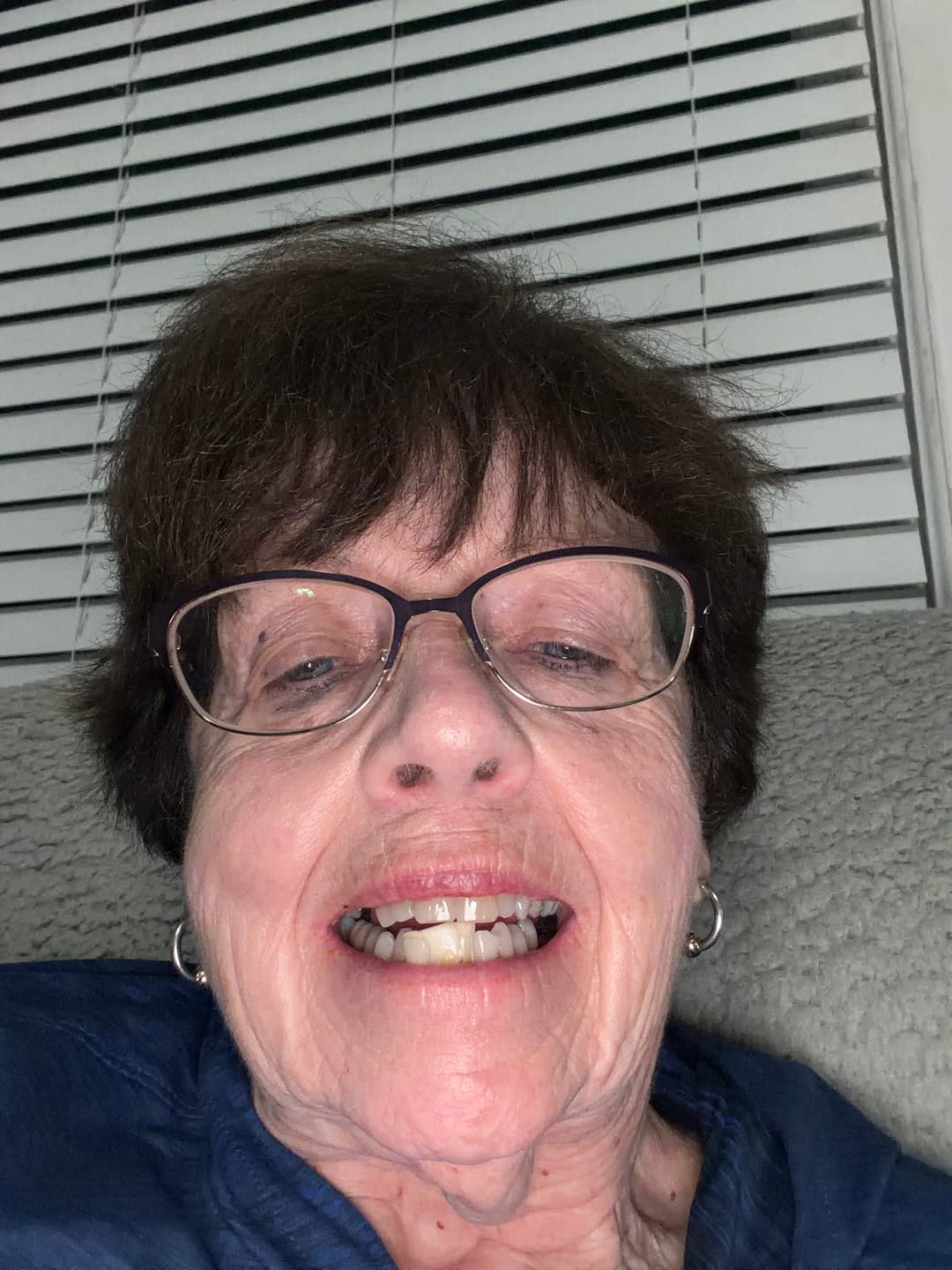 Customer photo review of Imako® Tooth Tinted Plastic – Temporary Tooth – For Chipped Tooth & Fill Gaps in Teeth
