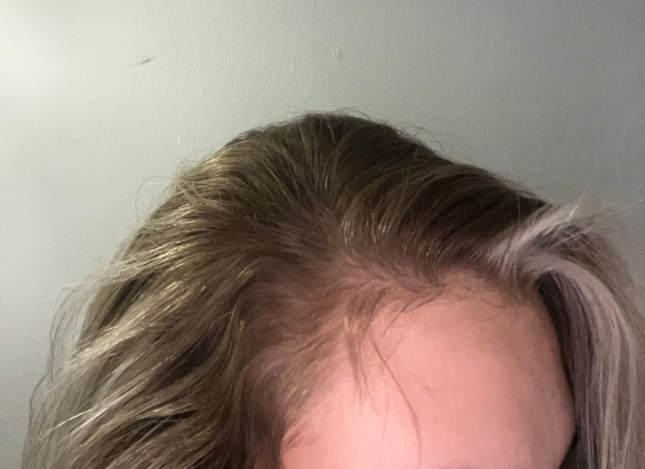 Customer photo review of Crown & Glory Vegan Hair Food Supplement