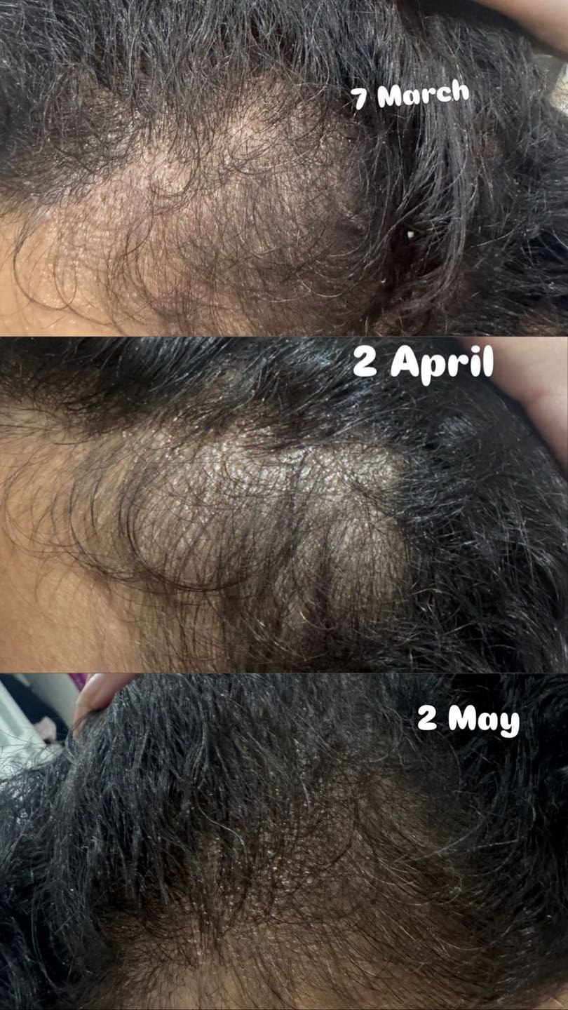 Customer photo review of VITAFOAM ™ Hair Growth Formula