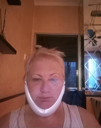 Customer photo review of ALISSEA V-SCULPT™  Dispositivo lifting facial EMS- LED tecnology