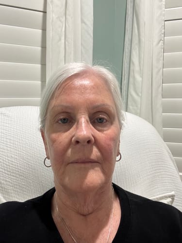 Reviewer's after photo showing smoother facial skin after 5 weeks of using the Anti-Aging Skincare Trio.