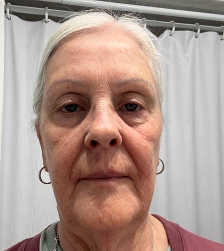 Reviewer's before photo showing her facial skin prior to using the Anti-Aging Skincare Trio.