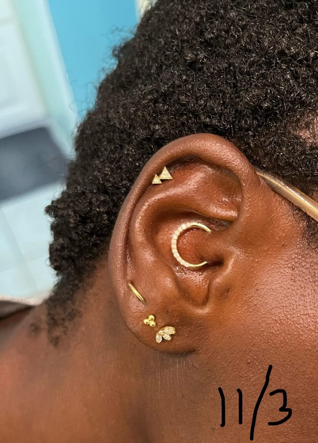 Customer photo review of Keloid Bump Removal Gel