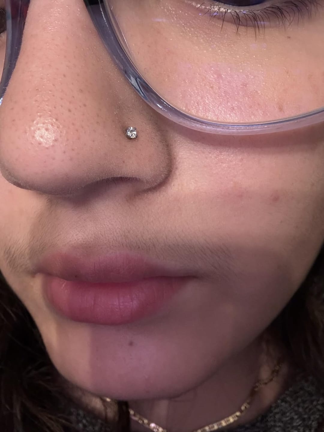 Customer photo review of Keloid Bump Removal Gel