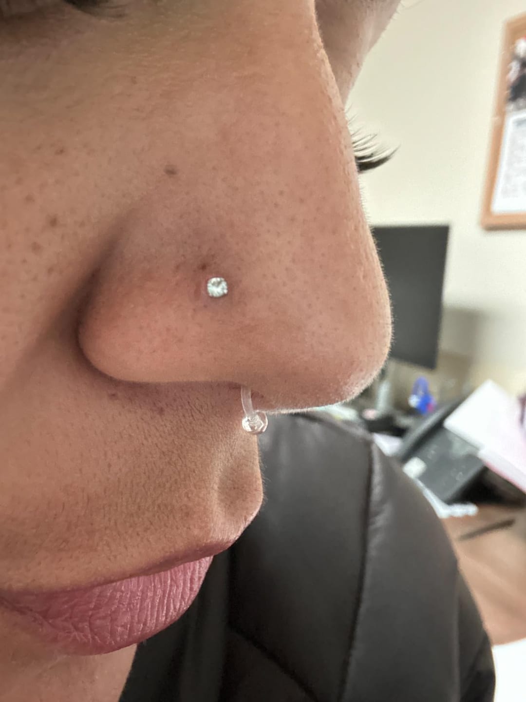 Customer photo review of Keloid Bump Removal Gel