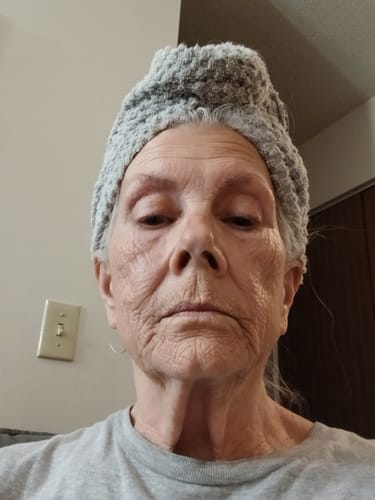 Customer selfie showing facial skin texture for their review of the Microneedling Infusion System.