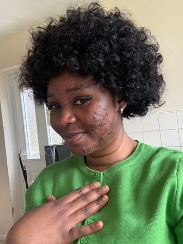 Customer smiling, showing visible improvement in acne on their cheek after using the Acne Prevention Kit.