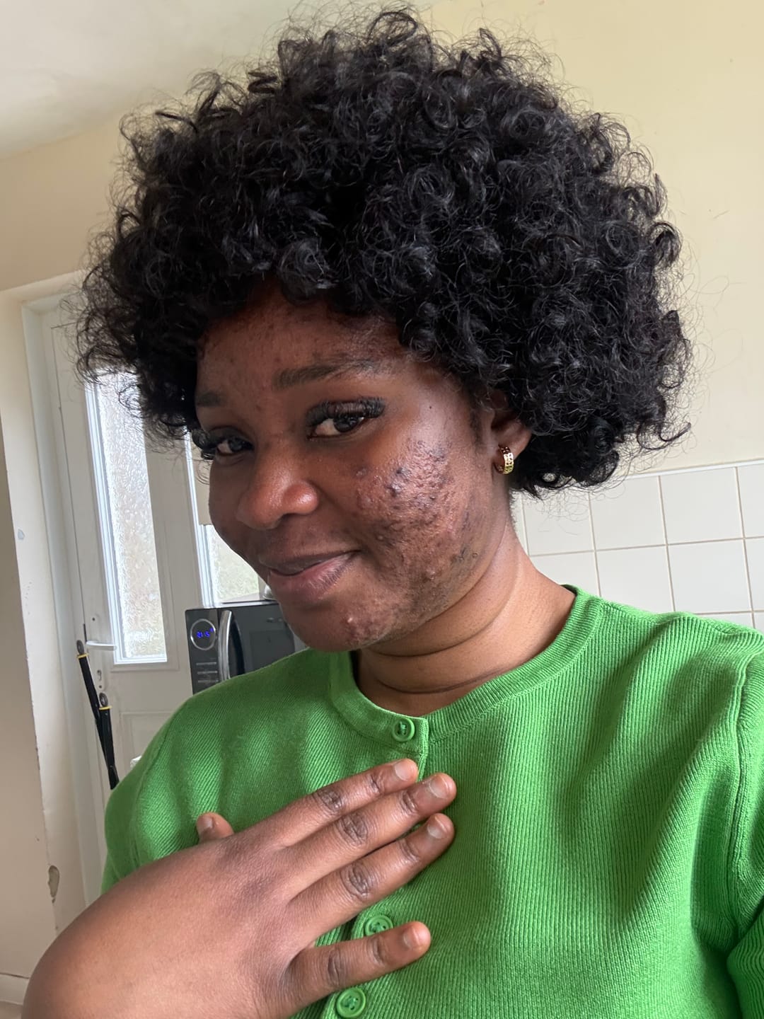 Customer photo review of Acne Prevention Kit