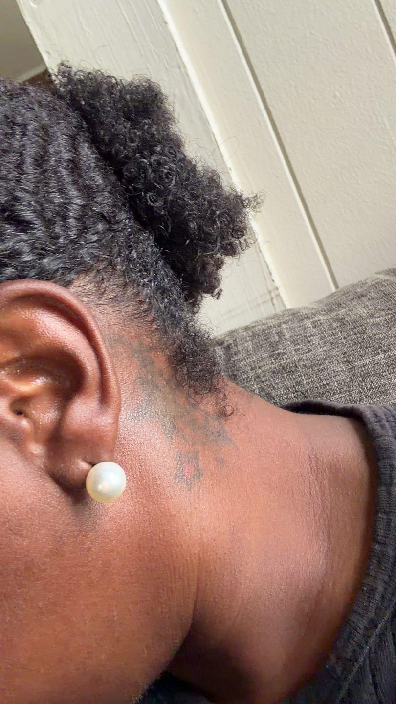 Customer photo review of Ear Lobe Support Patch