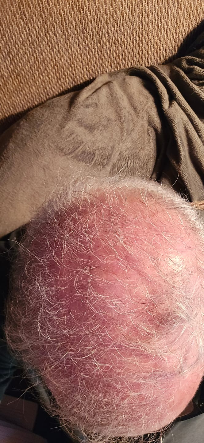 Customer photo review of Micro Infusion System ck-s1m