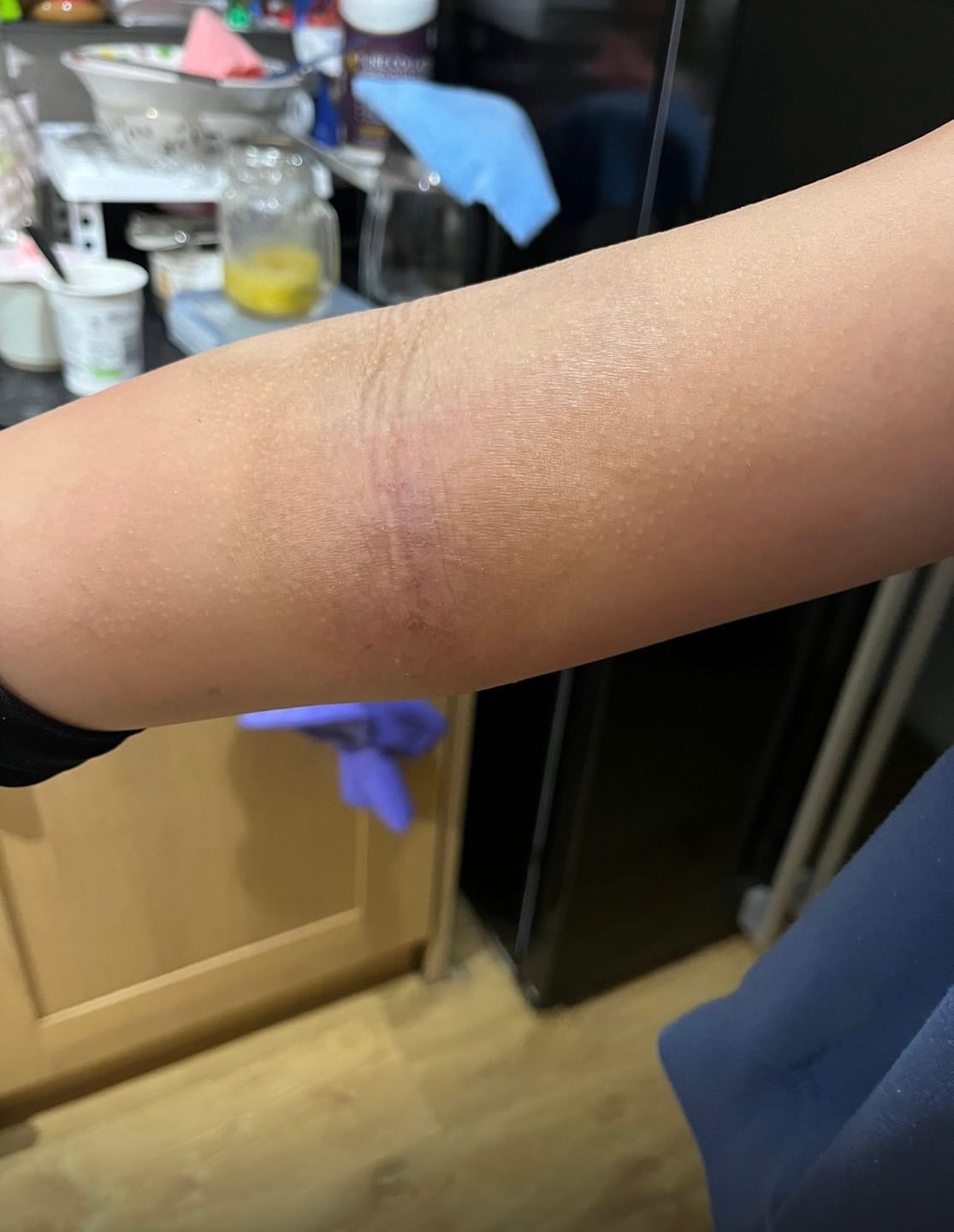Customer photo review of Herbal Psoriasis Relief Cream