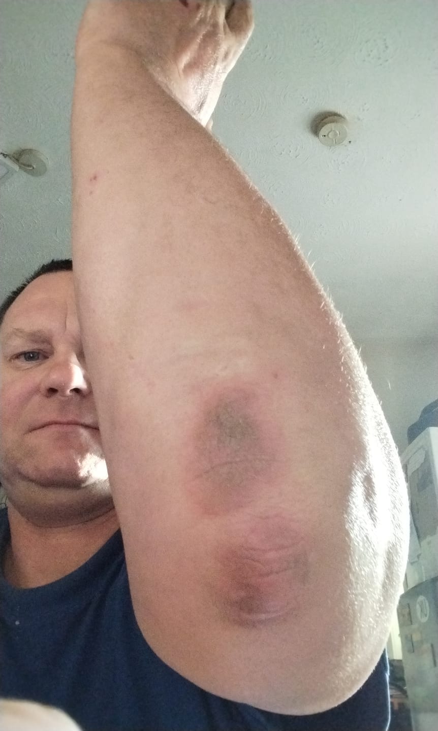 Customer photo review of Herbal Psoriasis Relief Cream