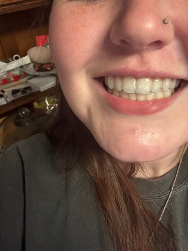 Reviewer smiling in a close-up, showing a clear retainer fitting over their teeth.
