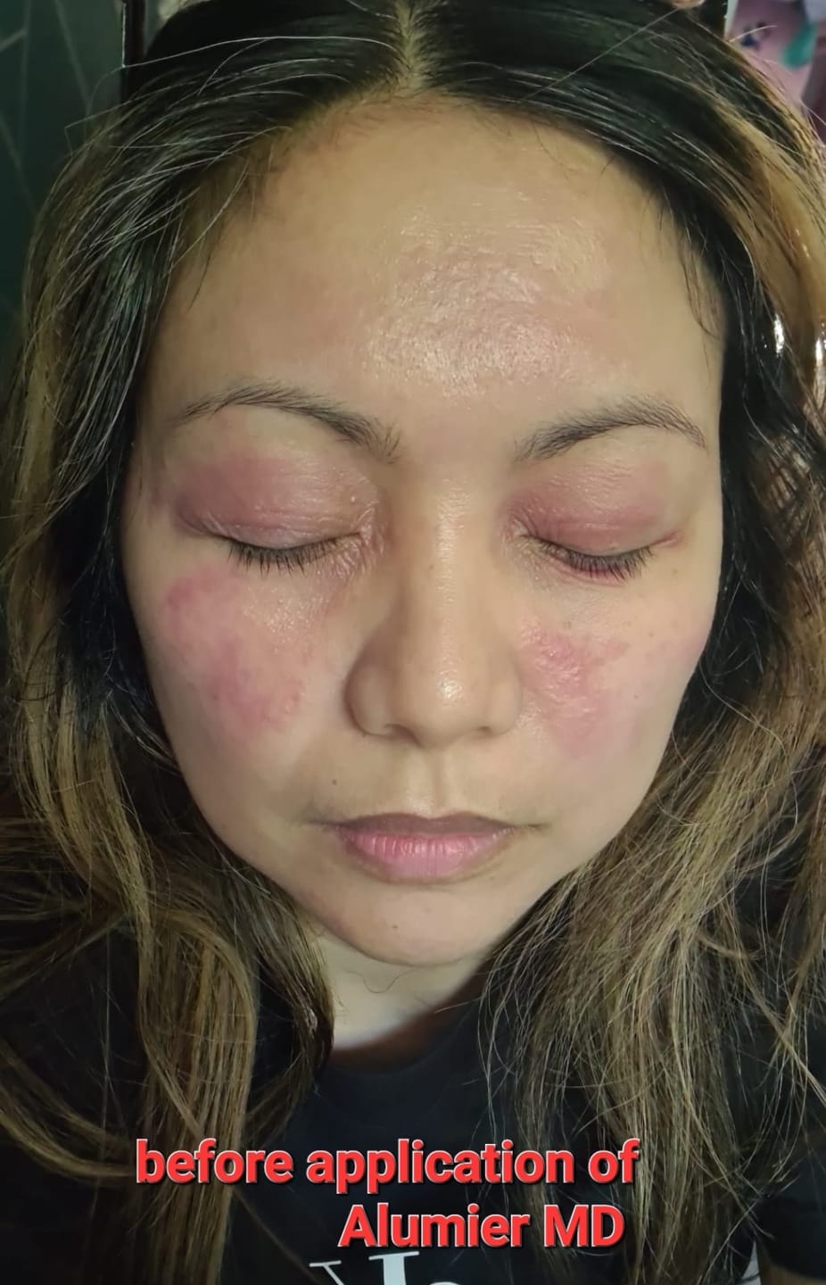 Customer photo review of Herbal Psoriasis Relief Cream