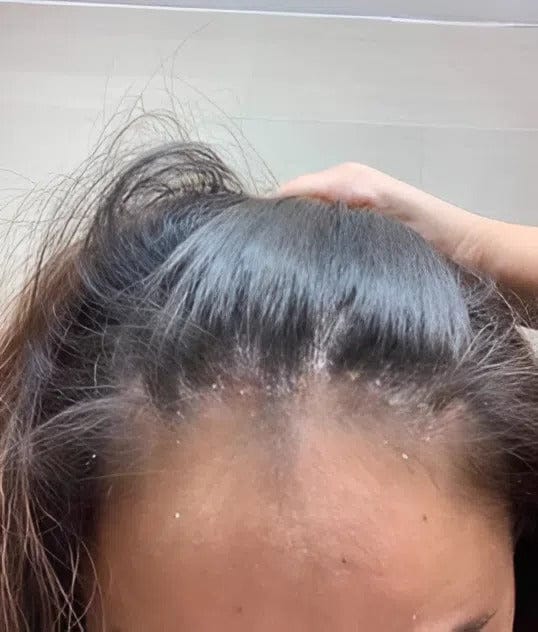 Customer photo review of Herbal Psoriasis Relief Cream