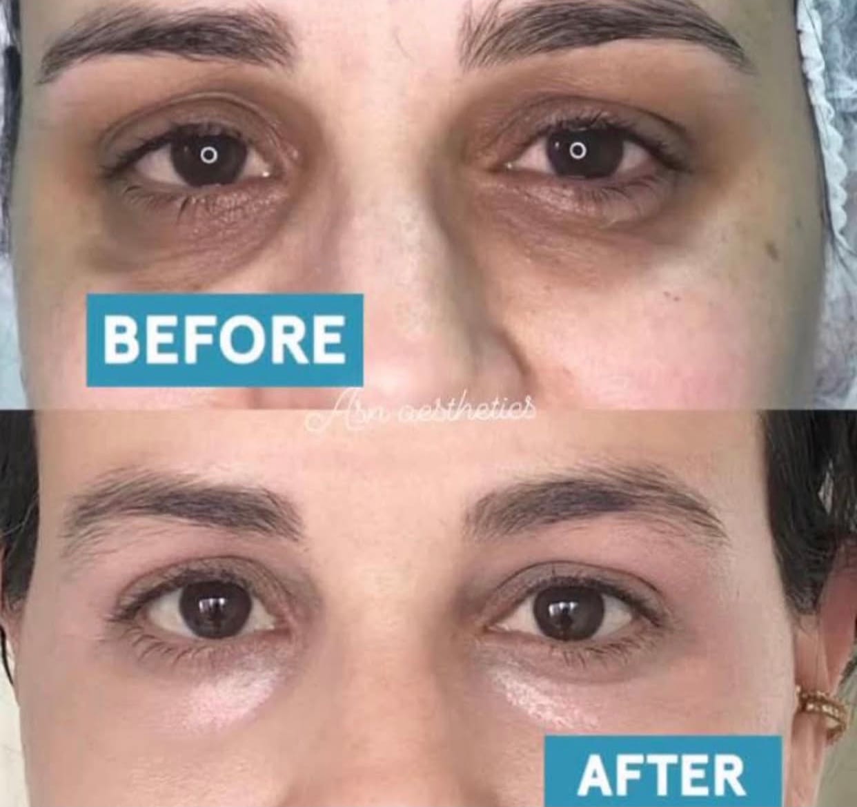 Customer photo review of Bakuchi Peptide Eye Crème