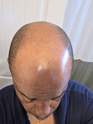 An overhead view of the reviewer's scalp, showing significant hair thinning on the crown.