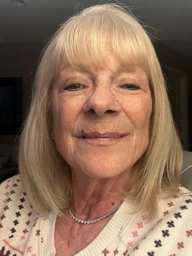 Reviewer's close-up photo showing her facial skin after treatments with The Micro Infusion System.