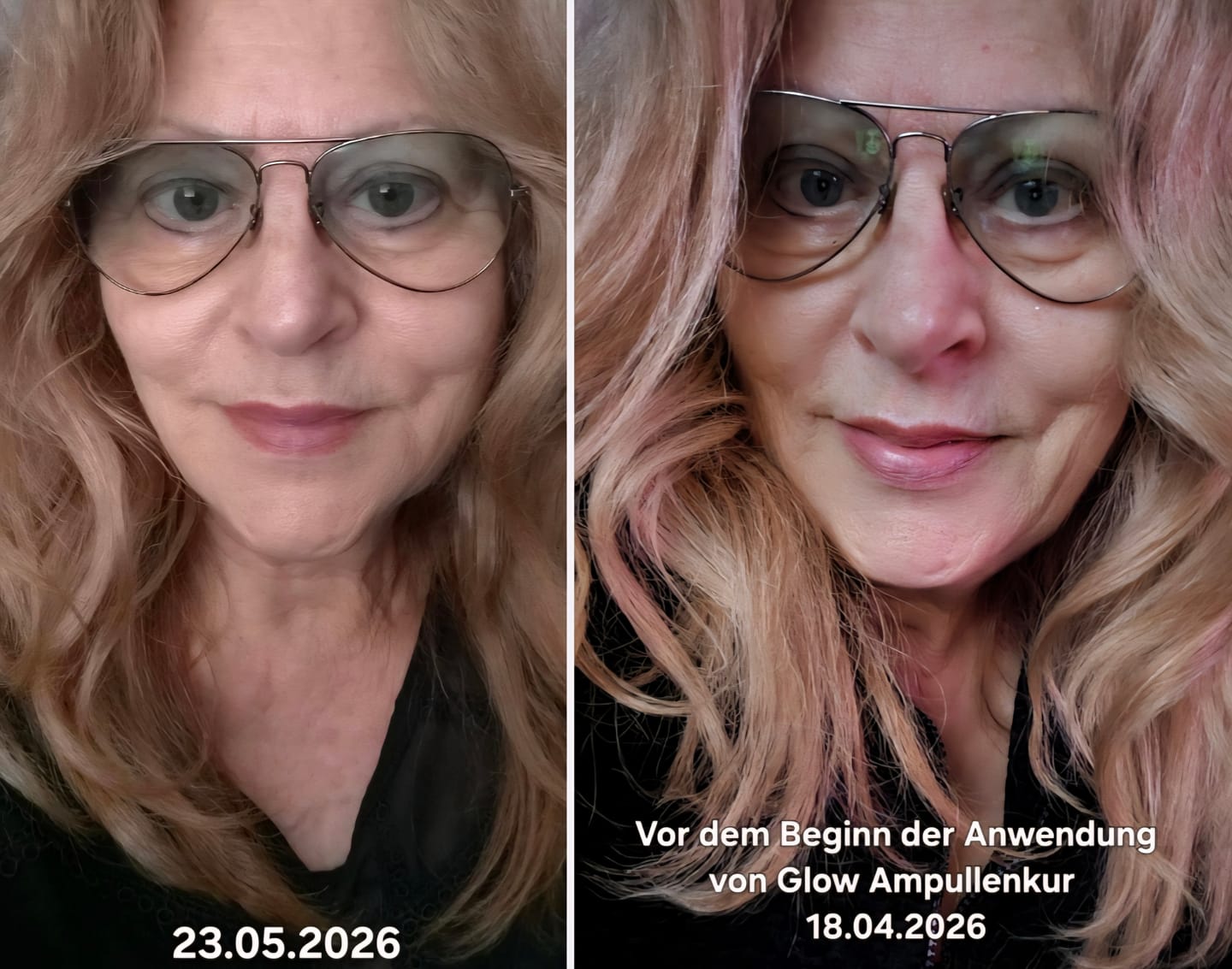 Customer photo review of Natural Botulin Glow Ampullenkur