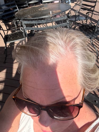 Reviewer's thinning hair at the hairline, showing scalp before using the Glov Hair Regrowth System.