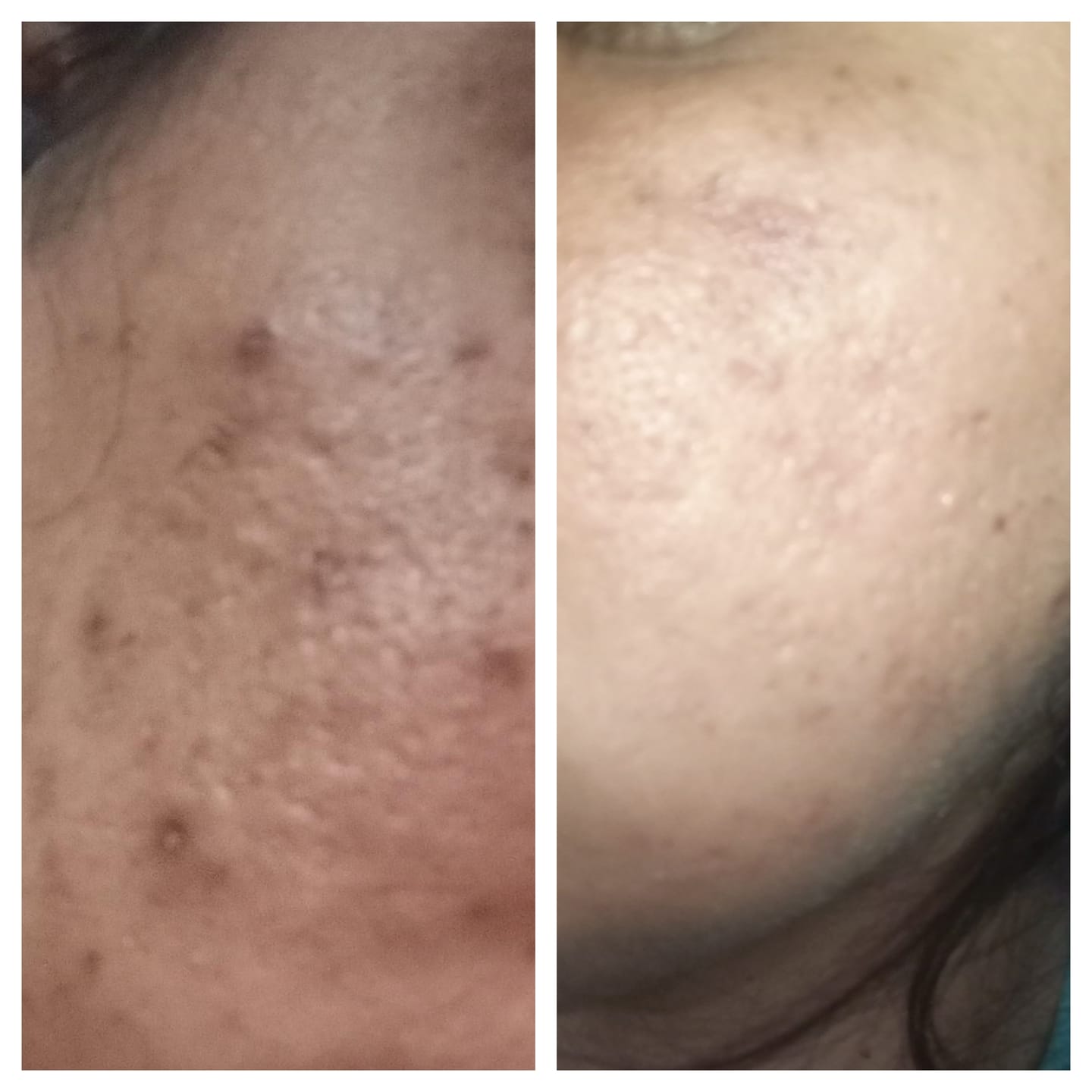 Customer photo review of Mela Care Advanced Brightening Cream