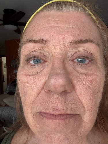 Reviewer's face showing deep wrinkles and skin texture before using the Micro Infusion System.