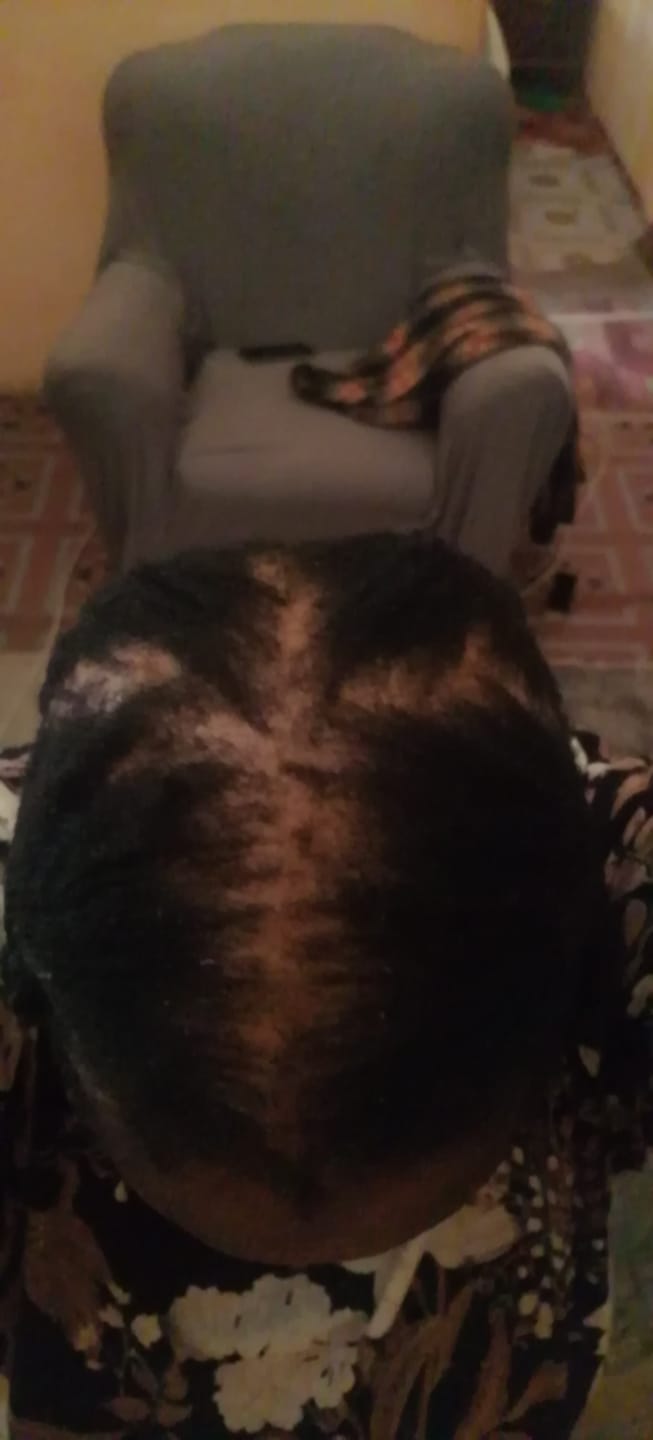 Customer photo review of Minoxidil REGULAR (2%) strength SOLUTION, 3month supply