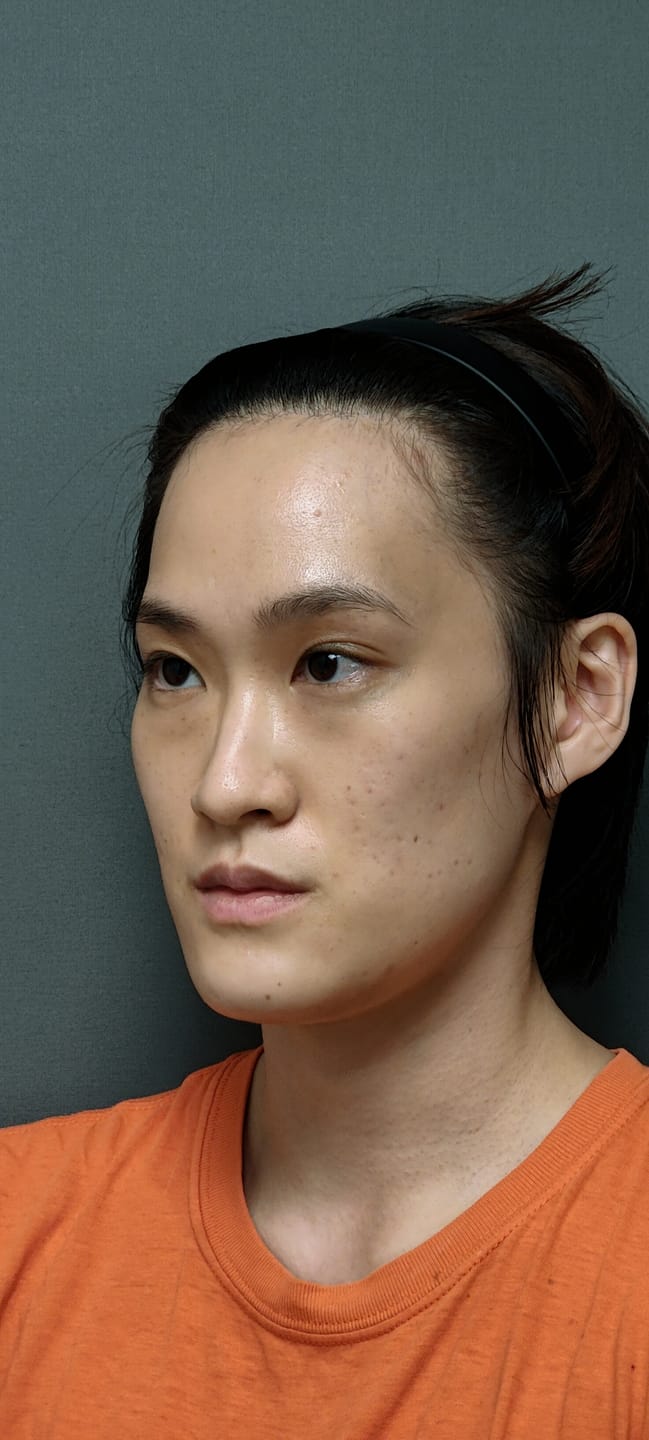 Customer photo review of Acne Formula