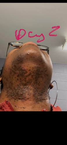 Customer shows chin and neck on Day 2, showing dark spots and stubble before using the Turmeric Brightening Soap.