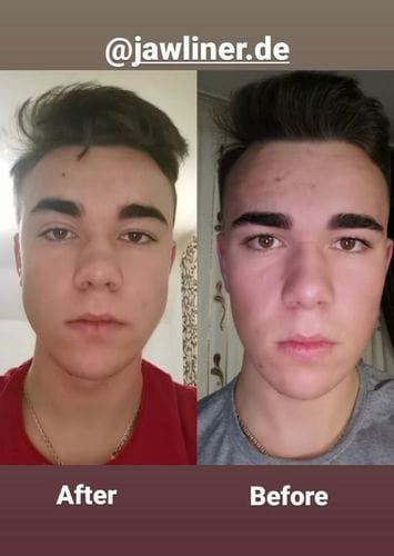Customer photo review of JAWLINER® 3.0 - Elite Edition - Beginner + Advanced