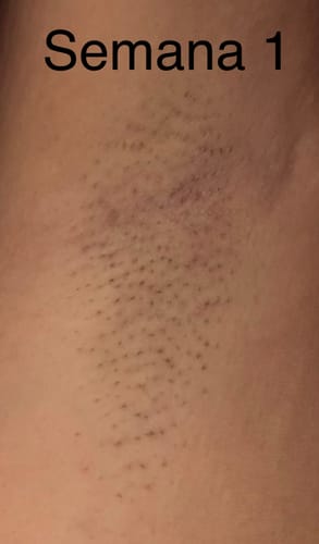 Customer photo review of Depiladora Premium IPL