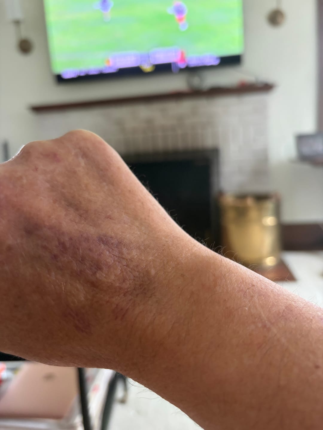 Customer photo review of Arnica Montana + Vitamin K Cream