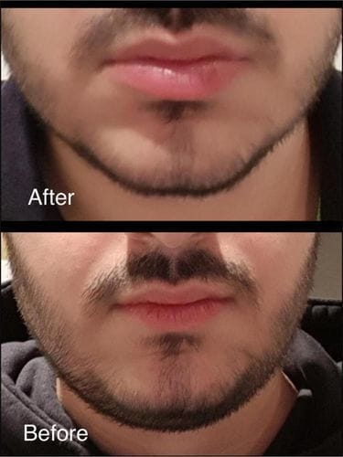 Customer photo review of JAWLINER® 3.0 - Elite Edition - Beginner + Advanced