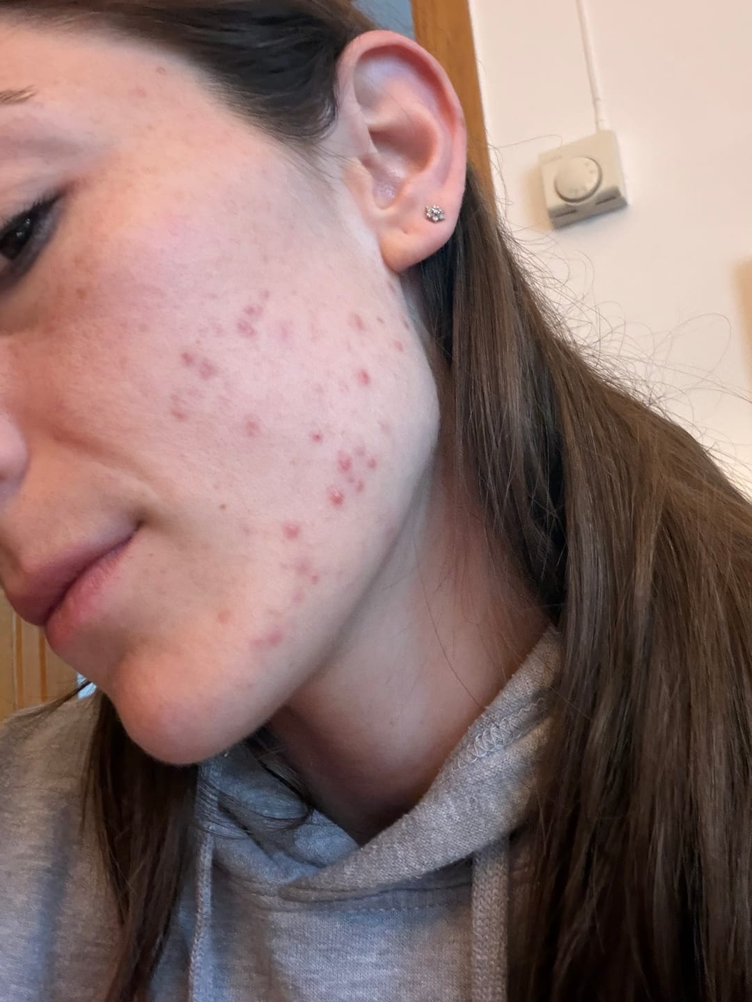 Customer photo review of A CONTROL - ACNÉ HORMONAL & RESISTENCIA A LA INSULINA