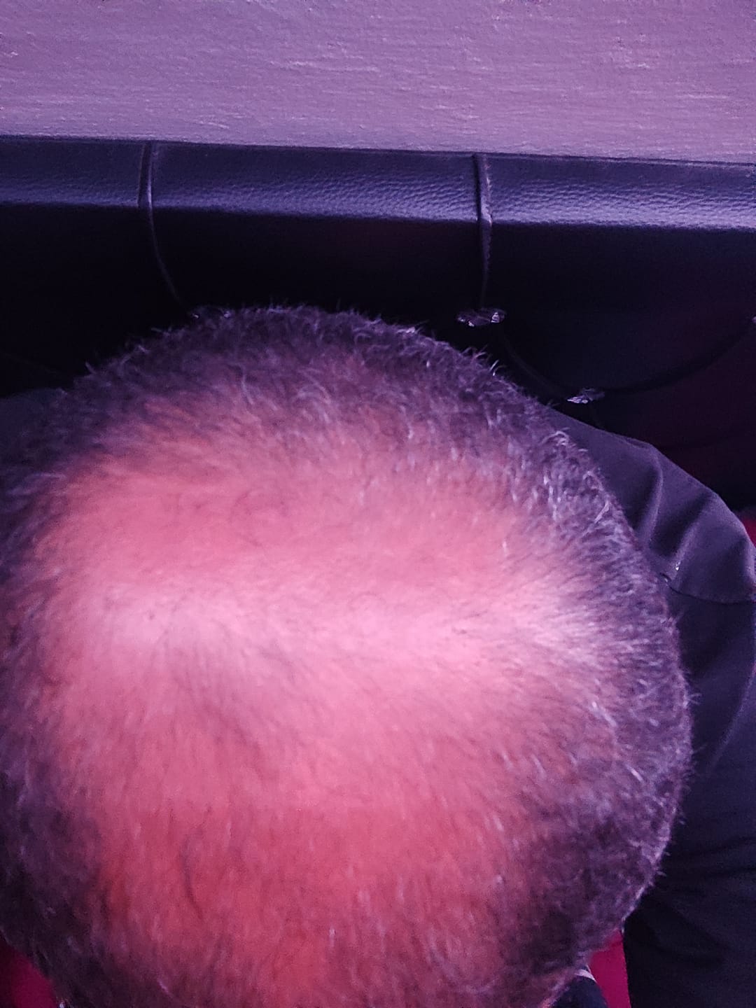 Customer photo review of Sérum au Redensyl Activateur de Pousse Cheveux