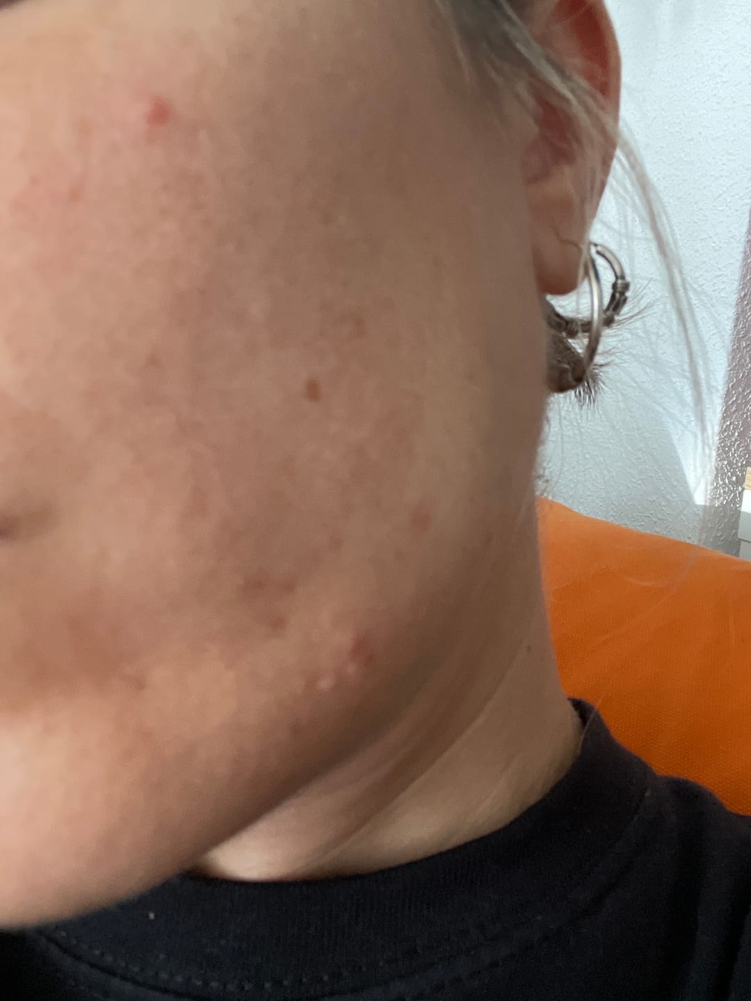 Customer photo review of A CONTROL - ACNÉ HORMONAL & RESISTENCIA A LA INSULINA