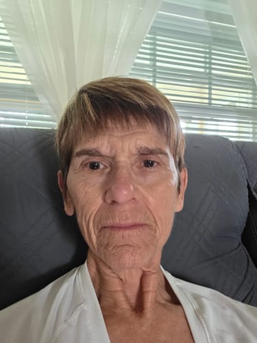 Reviewer shows their facial wrinkles and skin texture in a selfie for their Seranova Micro Infusion System review.
