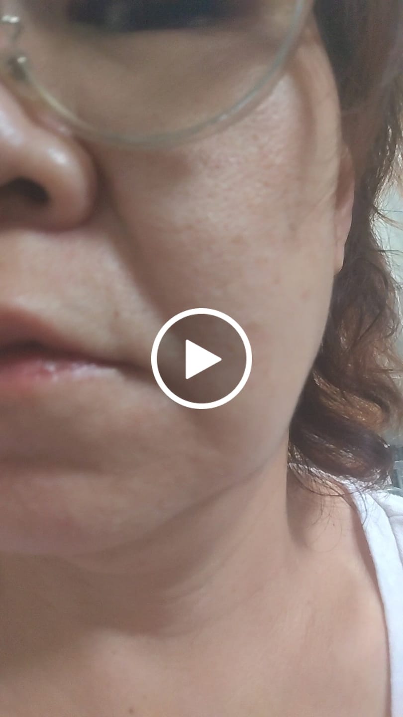 Customer video review of The Micro Infusion Pigmentation System™