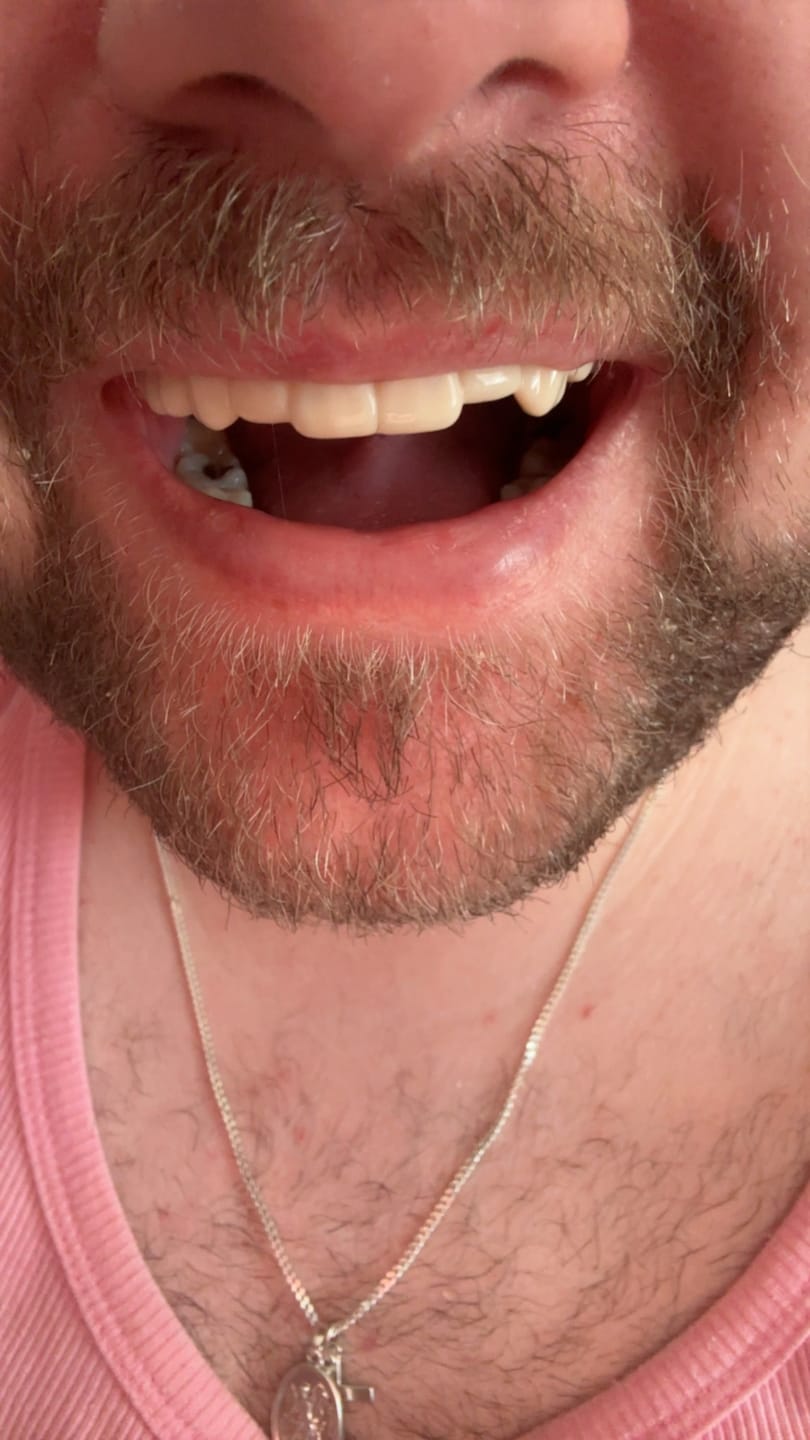 Customer photo review of Click-in Veneers 4.0