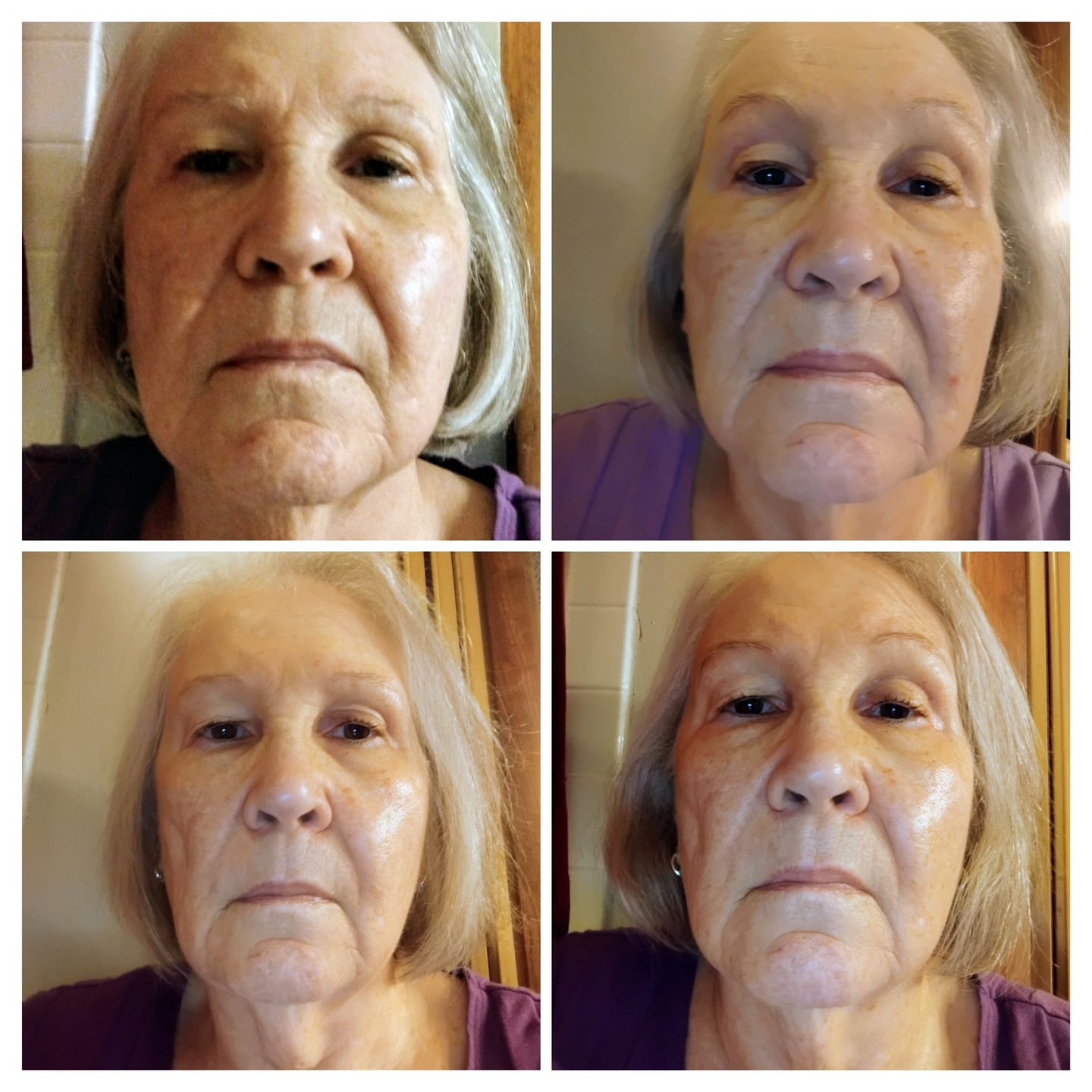 Customer photo review of 6 Month Supply - Deep Collagen Cream