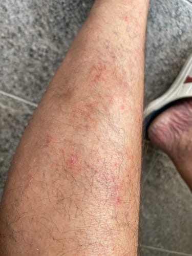 Vásárló mutatja a piros, irritált bőrét a lábán, amit a SERENI krémmel kezel.