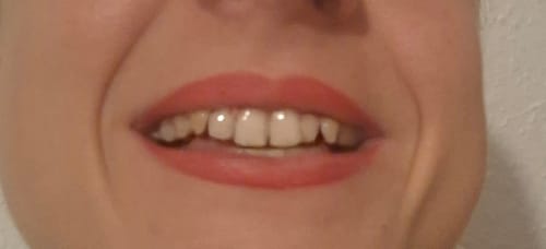 Közeli kép: Vásárló mosolya, amely a DentaGlow Fogfehérítő csíkok használata utáni fehér fogakat mutatja.