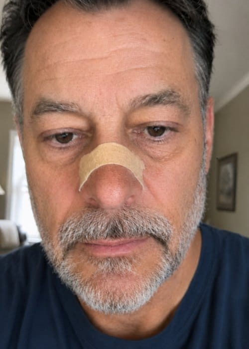 Customer photo review of nordicalm™ Nasal Strips for Sleep