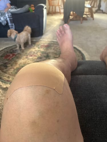 Customer photo review of Easy Kinesiology Tape (30-Day Supply)