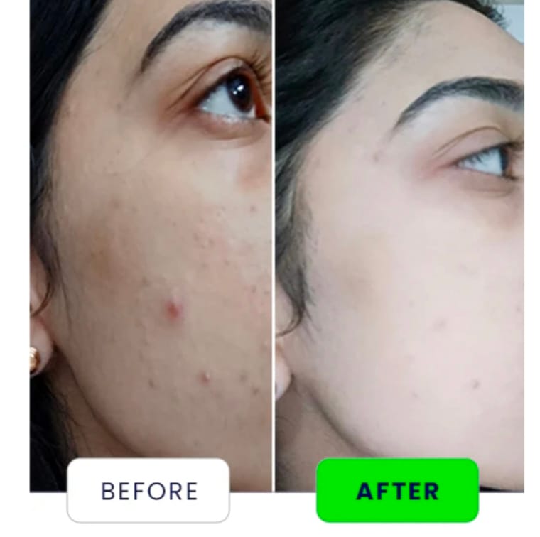 Customer photo review of NIACINAMIDE GLOW DROPS - with HA & Vit B5