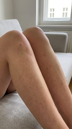 Customer photo review of DEPILO – Dauerhaft Haarfrei Bundle