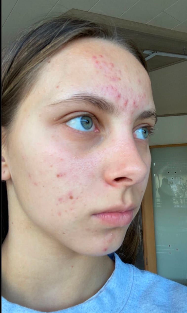 Customer photo review of 3in1 Ampullen    Glow • Anti-Aging • Akne
