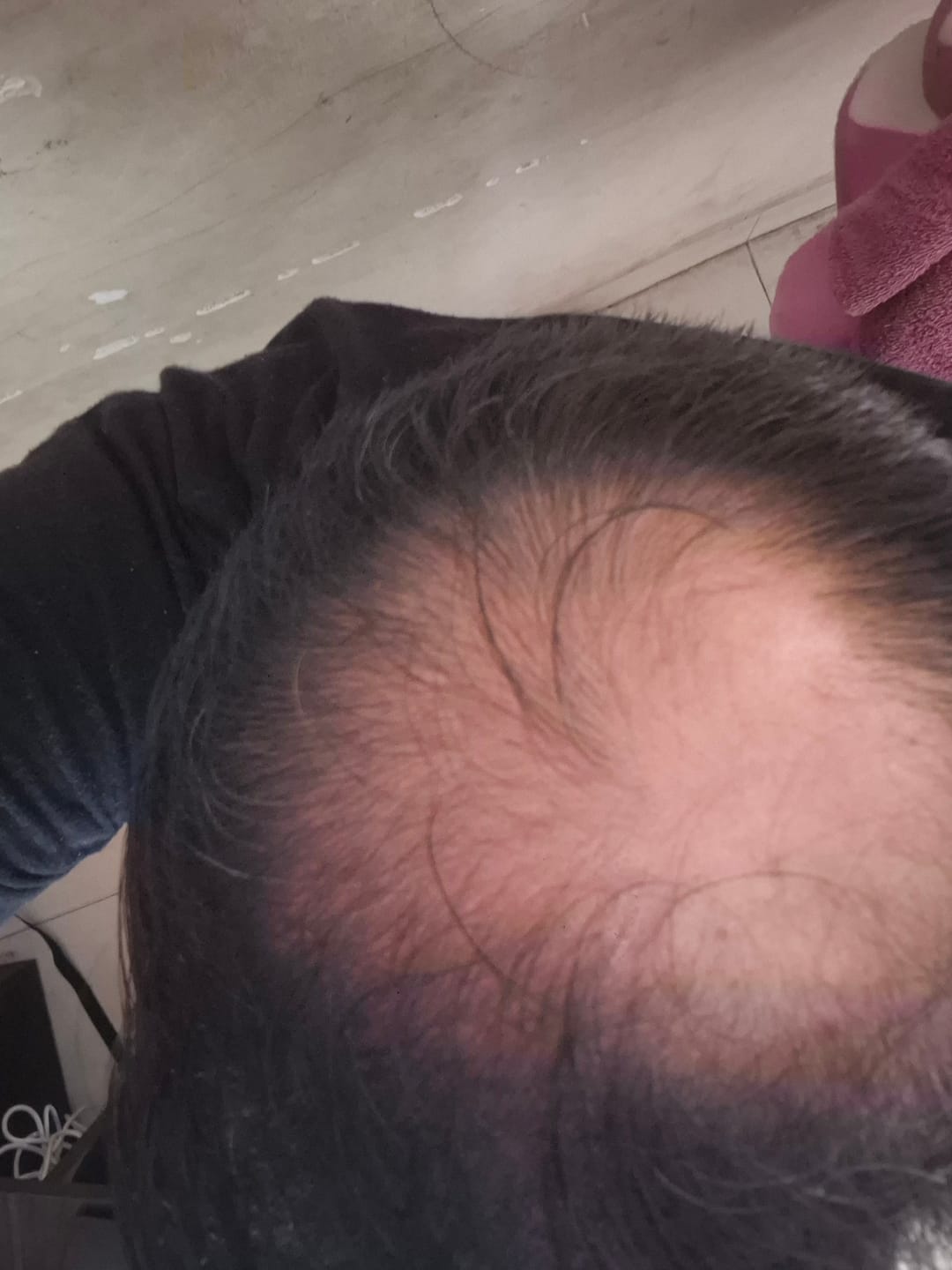 Customer photo review of Advance Hair Growth Serum 2.0 (30ml)