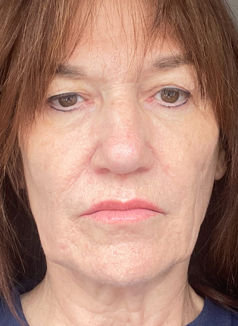 Customer photo review of The Micro Infusion System™