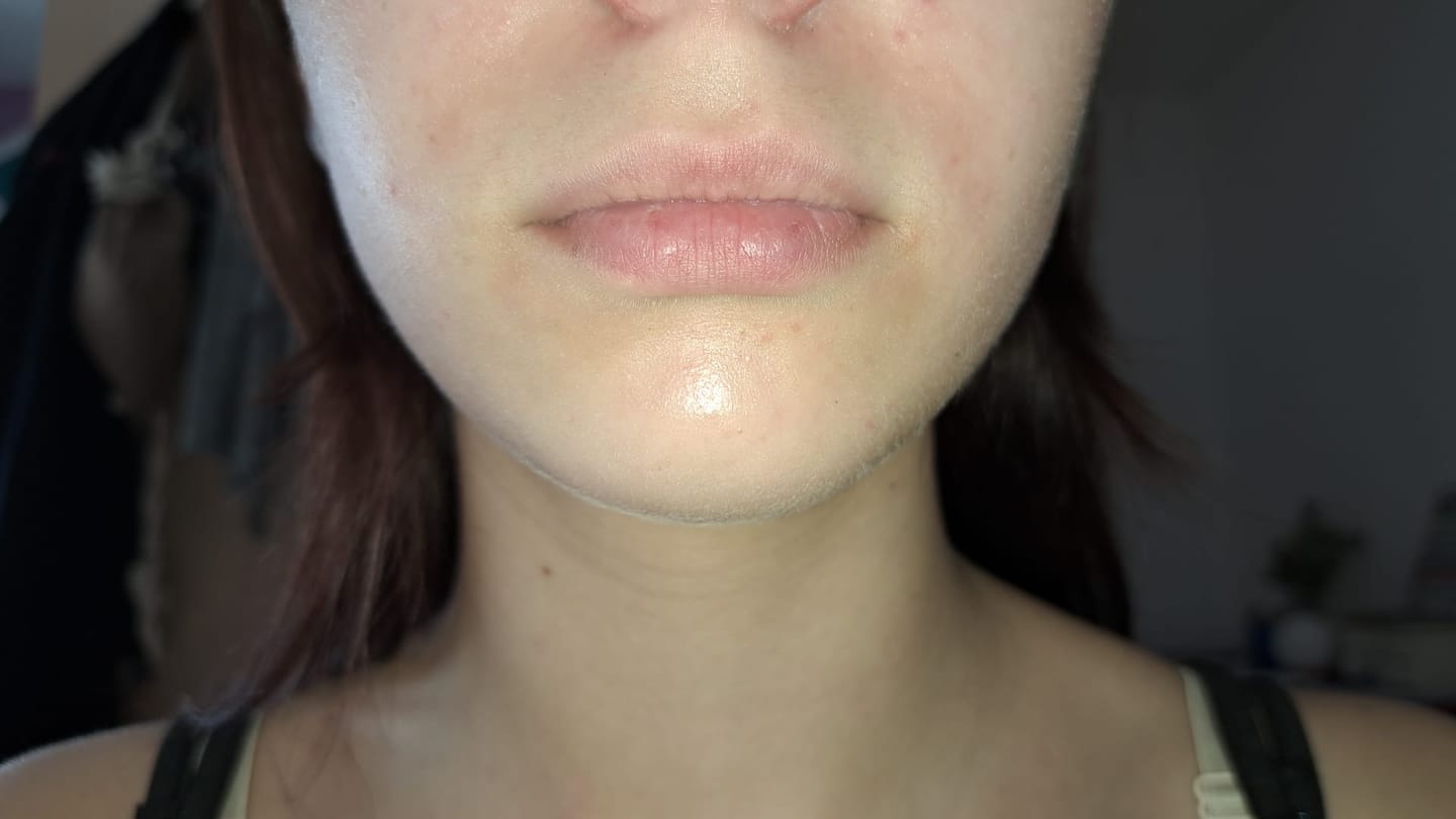 Customer photo review of 3in1 Ampullen    Glow • Anti-Aging • Akne